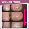 ToenailCorrector™ Patches